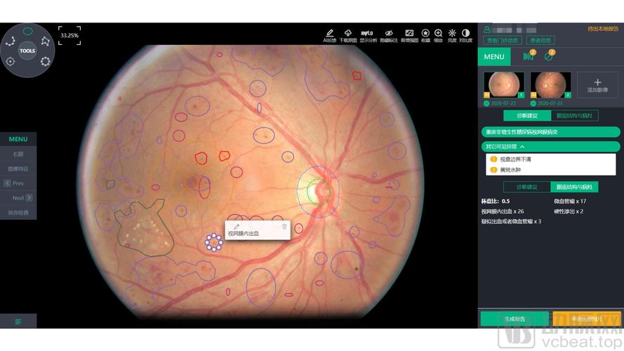 北京致远慧图科技的医疗 ai 产品之一,糖尿病视网膜病变眼底